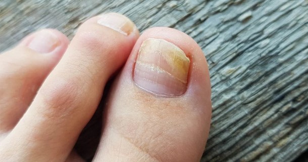 Hilfe gegen Nagelpilz