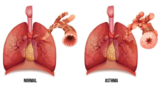 Gesunde Lunge und Asthmatiker-Lunge im Vergleich